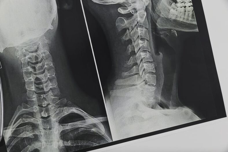 Osteochondrozės pažeistos kaklo stuburo rentgeno nuotrauka