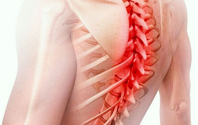 krūtinės ląstos stuburo osteochondrozė
