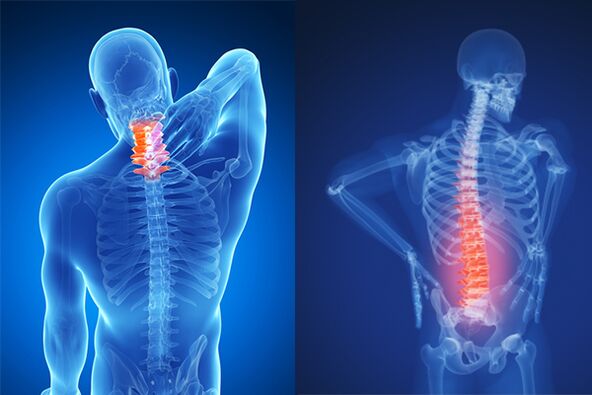 Gimdos kaklelio ir juosmens stuburo osteochondrozė