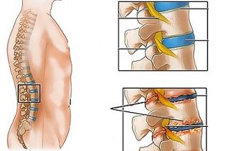 Juosmens osteochondrozės priežastys