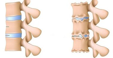 Kaip atpažinti juosmens osteochondrozę