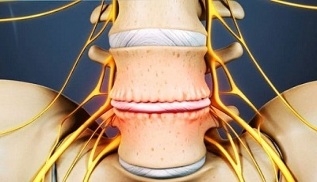 pagrindiniai gimdos kaklelio osteochondrozės simptomai